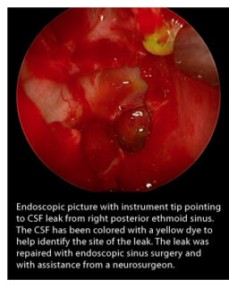 CSF Leak Repair | Raleigh Capitol Ear, Nose, and Throat | Blog